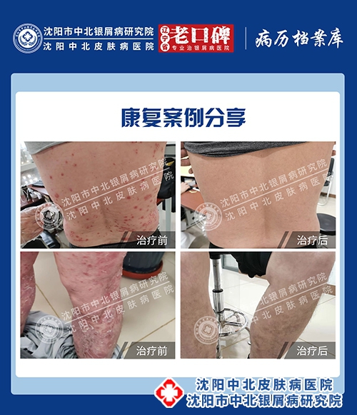 沈阳中北银屑病研究院银屑病康复案例分享