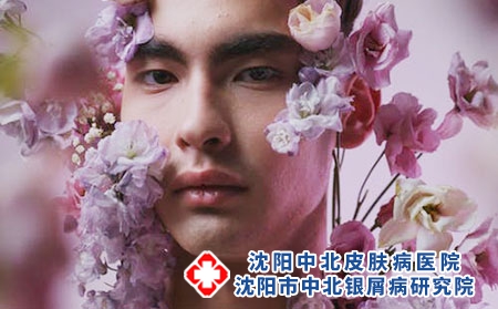 沈阳哪里可以治疗牛皮癣好点