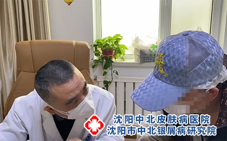 沈阳专业的银屑病医院是哪家?牛皮癣的病症常识?