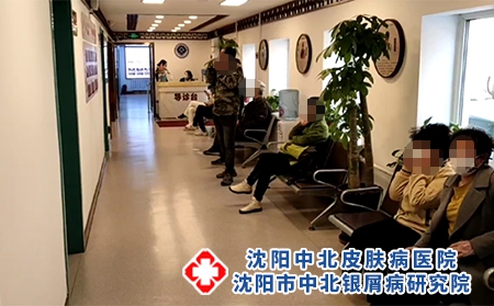 沈阳医院治银屑病-沈阳哪有治银屑病的