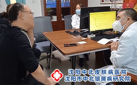 沈阳银屑病皮肤科-沈阳牛皮癣去哪里治