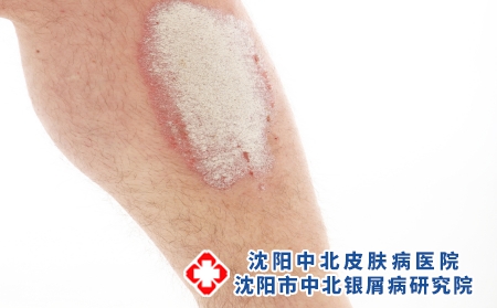 摄图网_321241050_小腿上的牛皮癣或牛皮癣-特写（企业商用）