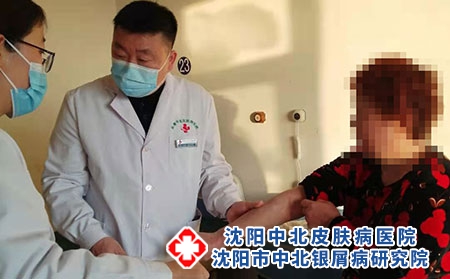 长春大牛皮癣医院-长春银屑病研究院可靠吗