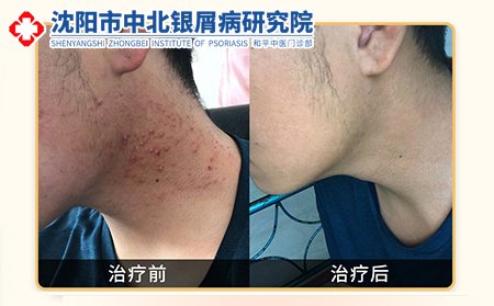 沈阳中北皮肤病医院案例对比