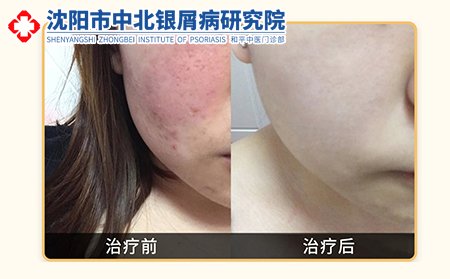 沈阳中北皮肤病研究院案例对比