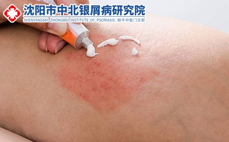牛皮癣患者日常要如何做好护理