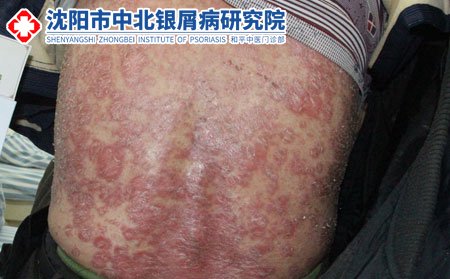 牛皮癣发病后大量脱屑危害有哪些呢