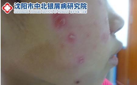 沈阳中北银屑病研究院能治好银屑病沈阳治疗银屑病专业医院