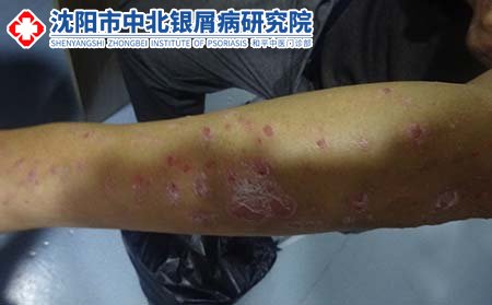 沈阳中北银屑病研究院贵吗费用