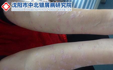 沈阳牛皮癣医院收费贵不