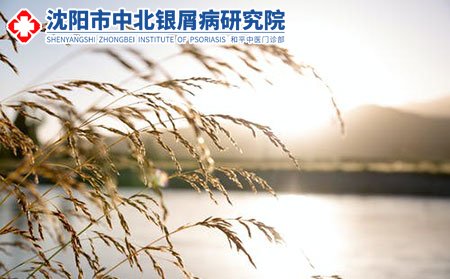 沈阳中北银屑病研究院治疗银屑病好不好