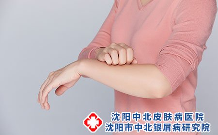 沈阳中北治疗银屑病医院