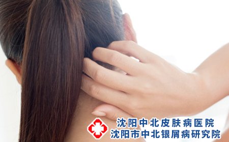 西医和中医治疗银屑病哪个好，西医怎么治