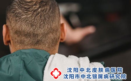 银屑病总发作的原因有些什么