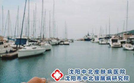 银屑病正确治疗的方法是什么